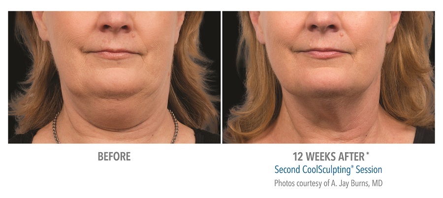 Female submentum chin 12 weeks after coolsculpting