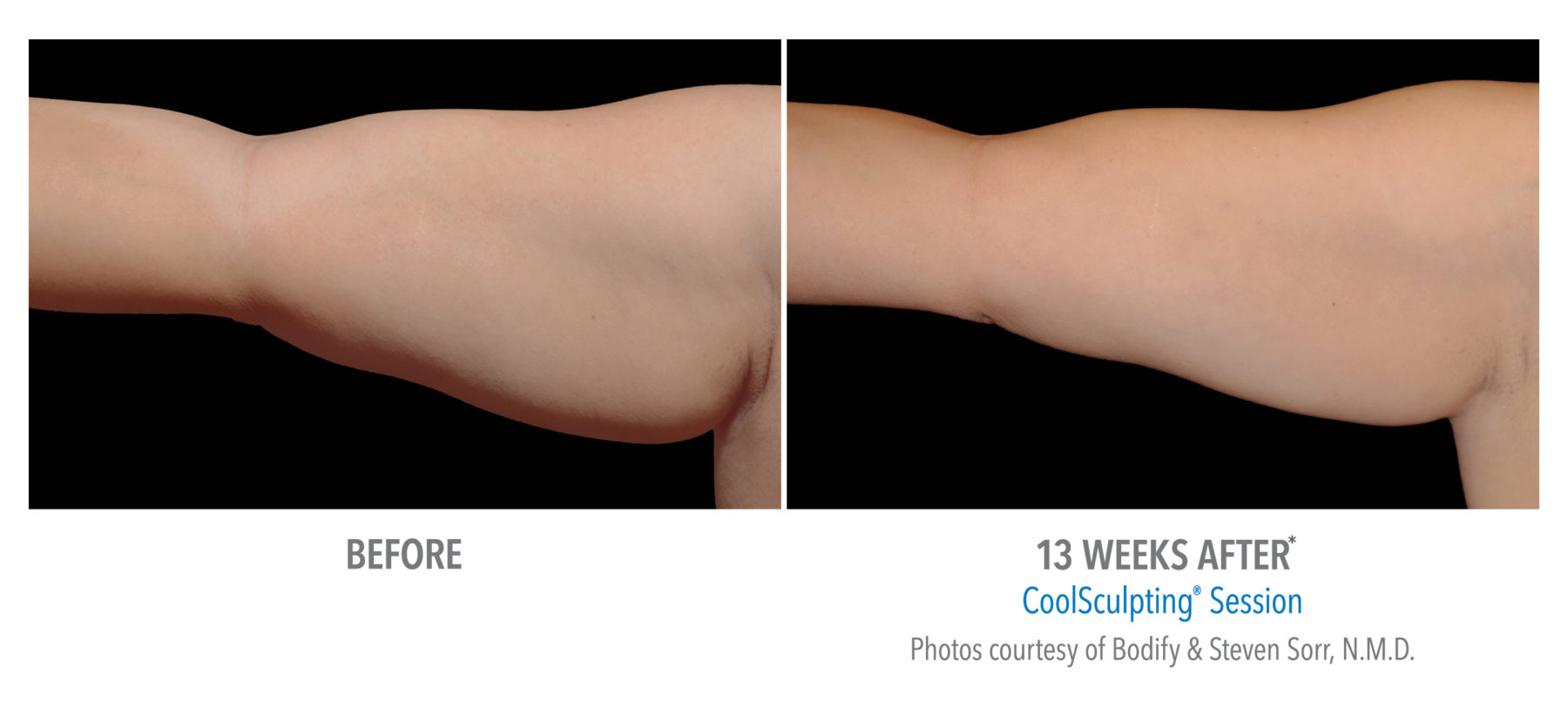 Female arm 13 weeks after coolsculpting