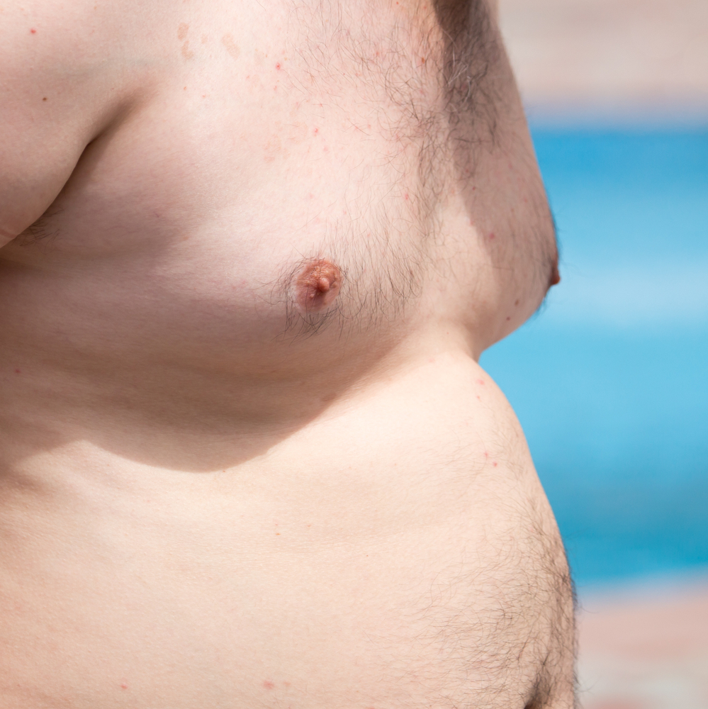 CoolSculpting for gynecomastia