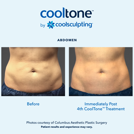 Transformation of the Week: Toning the Abdomen With CoolTone - The Body  Squad