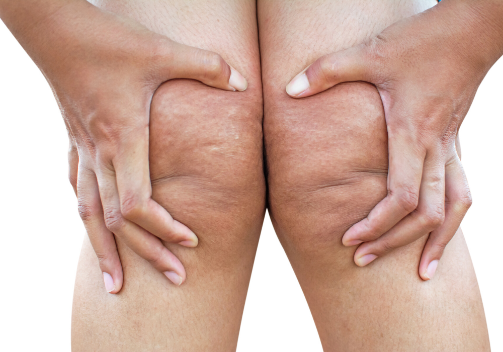 coolsculpting for knees in potomac