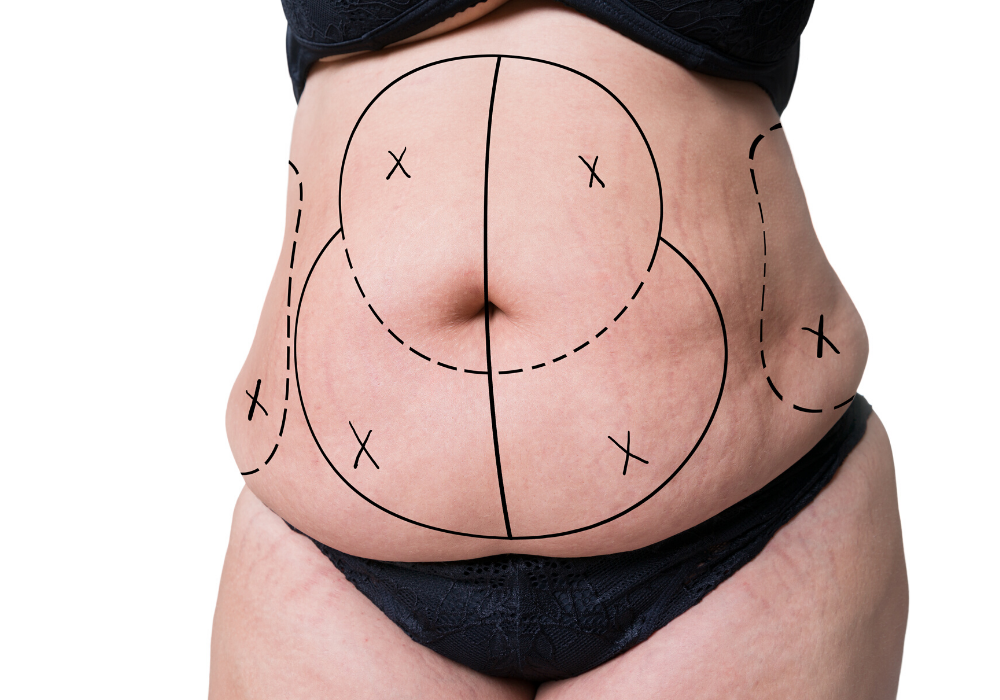 Body Contouring or Liposuction in Arlington, Which is Best?