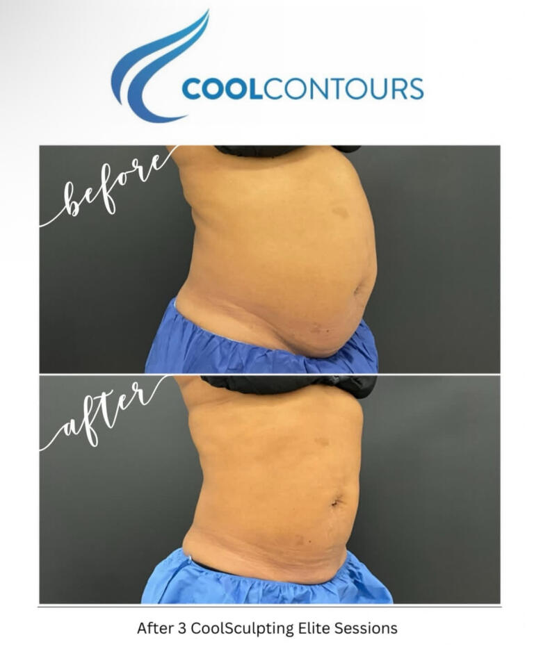 CoolSculpting Results Arlington VA | CoolContours_8118