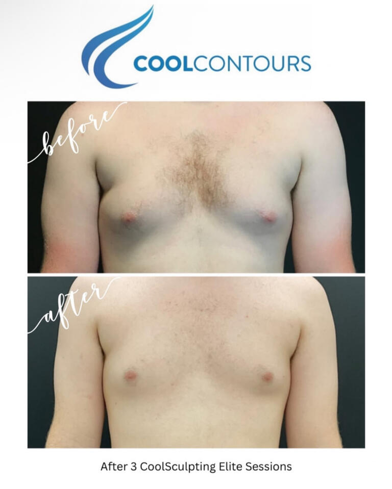 CoolSculpting Results Arlington VA | CoolContours_8120