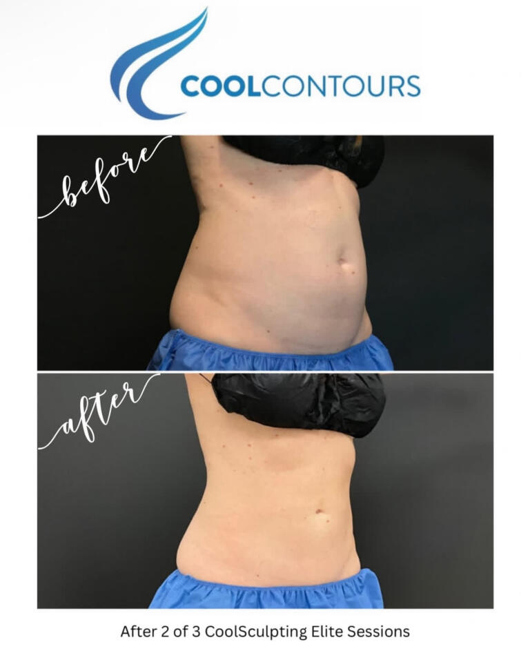 CoolSculpting Results Arlington VA | CoolContours_8122