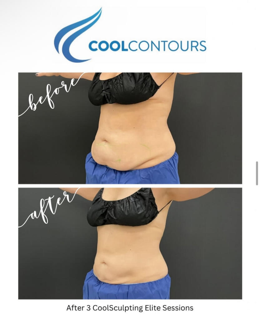CoolSculpting stomach before and after photo, Cool Contours Arlington VA