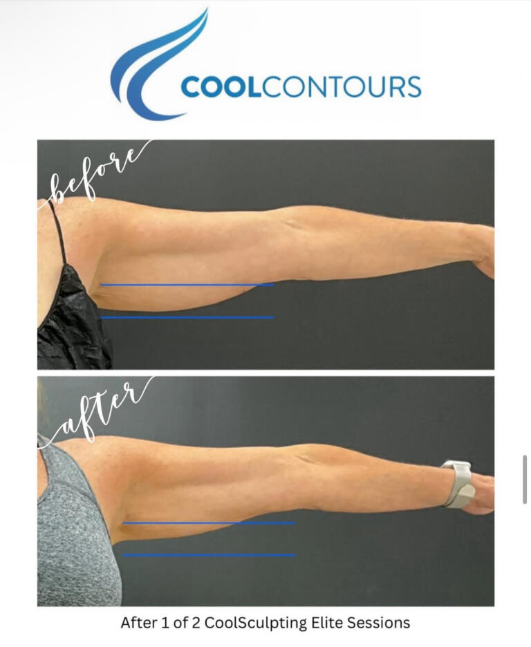 CoolSculpting Results Arlington VA | CoolContours_8129
