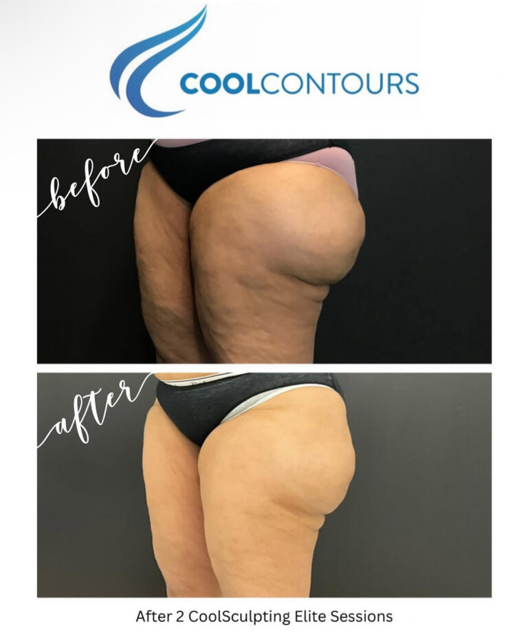 CoolSculpting Results Arlington VA | CoolContours_8130