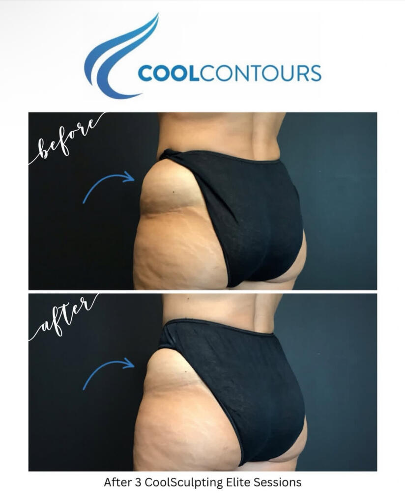 CoolSculpting thighs before and after at Cool Contours in Arlington, VA