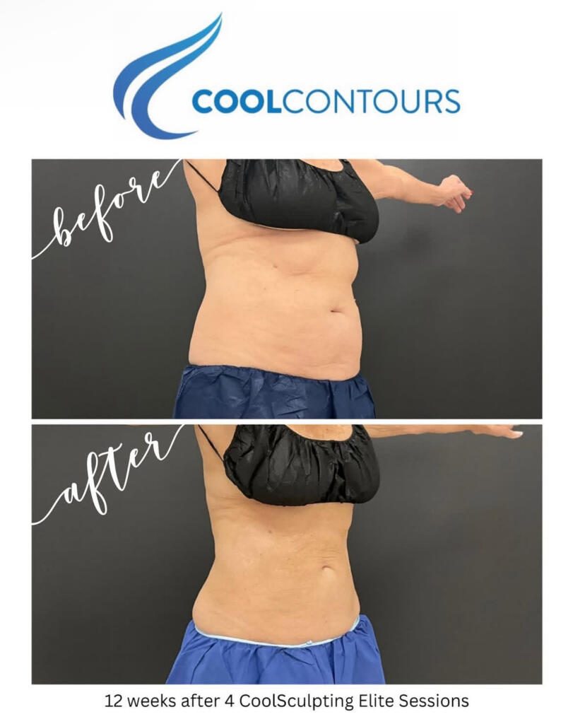 Abdomen treated with a customized CoolSculpting plan
