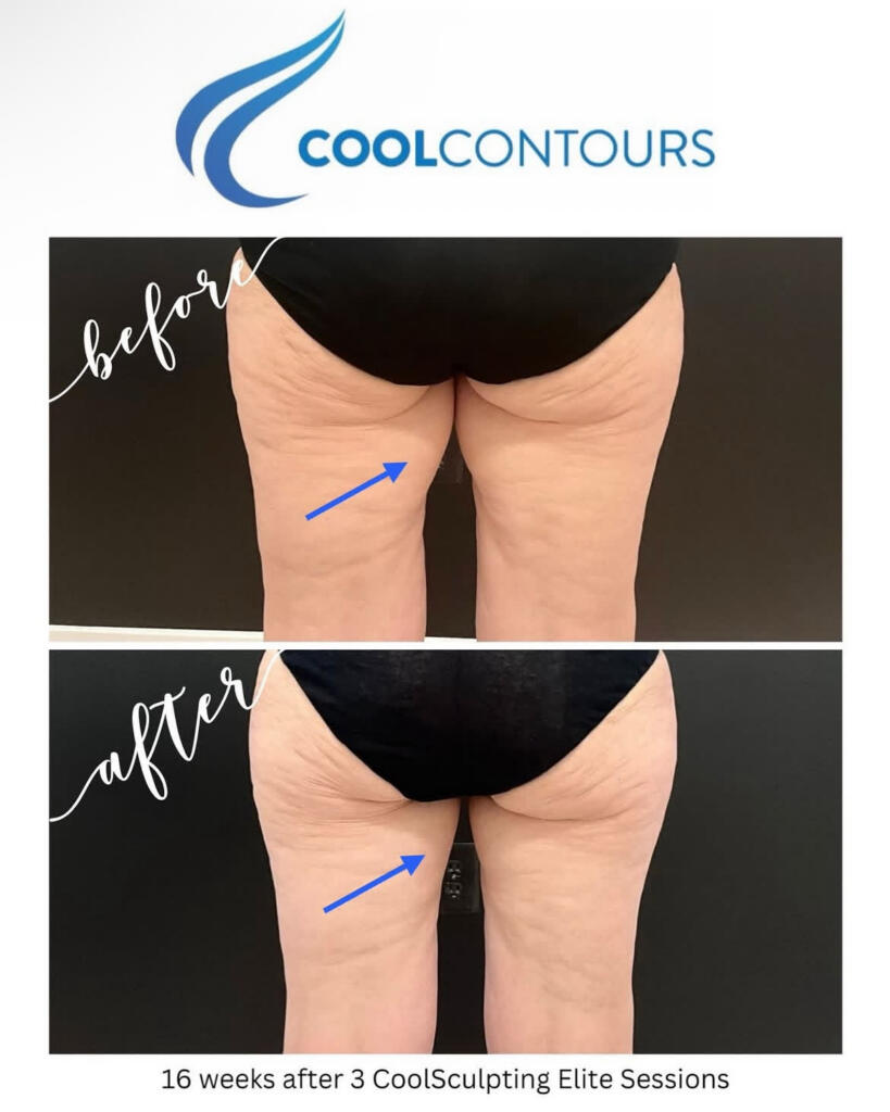 CoolSculpting inner thighs before and after at Cool Contours in Arlington, VA