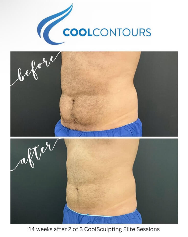CoolSculpting Results Arlington VA | CoolContours_8137