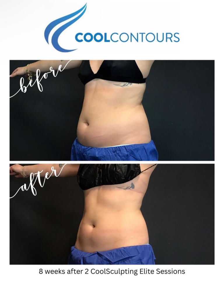 CoolSculpting Results Arlington VA | CoolContours_8138