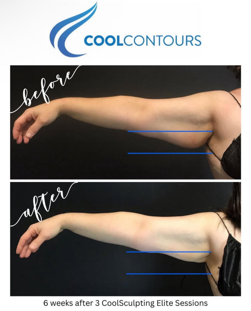 CoolSculpting Arm Fat Reduction Arlington VA