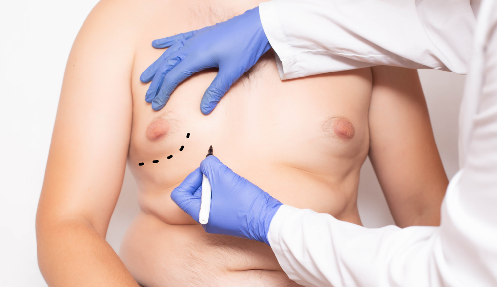 CoolSculpting for Man Boobs - Does It Work?