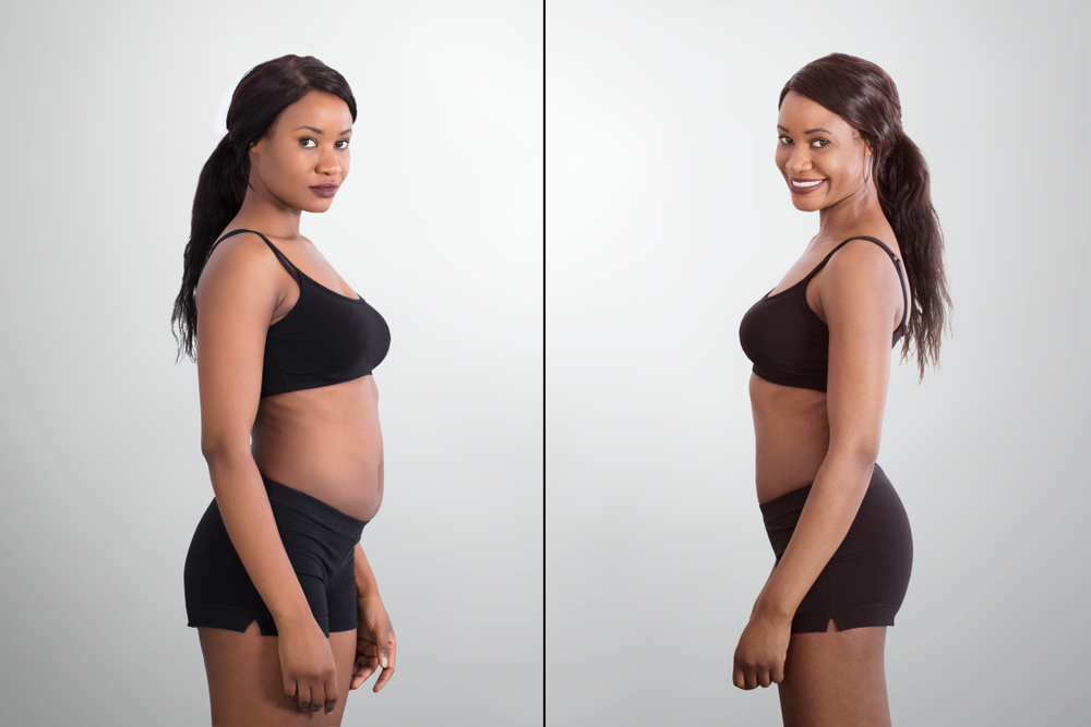 Non-Surgical Body Contouring vs. Liposuction: How to Choose?