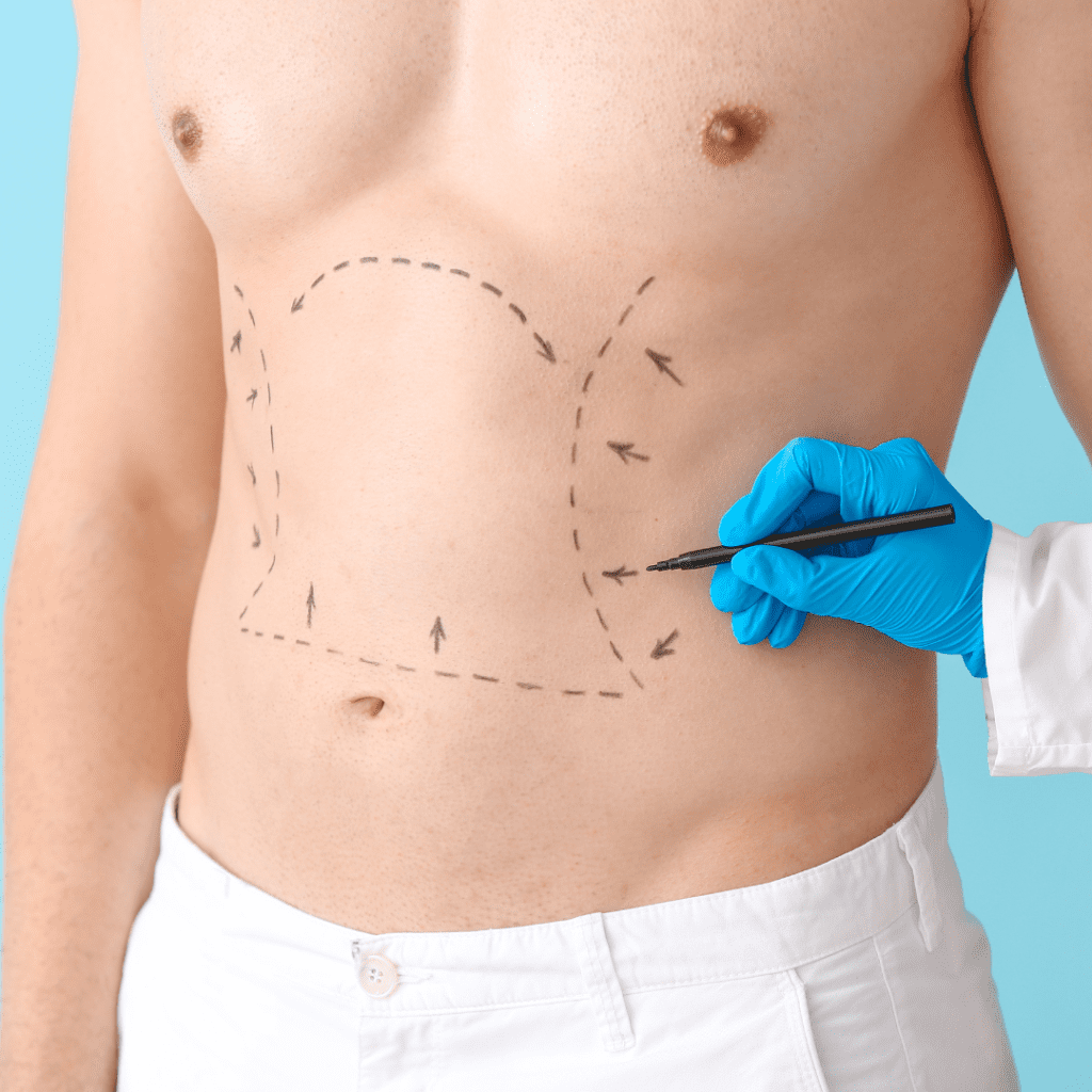 Patient getting liposuction markings when comparing price differences between sono bello and coolsculpting
