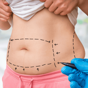 #1 CoolSculpting for Stomach Results in Northern Virginia
