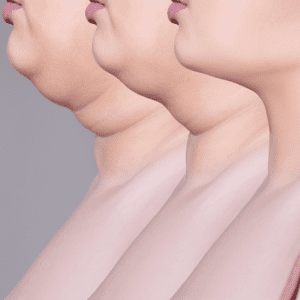 CoolSculpting or Kybella for Double Chin Which Is Better