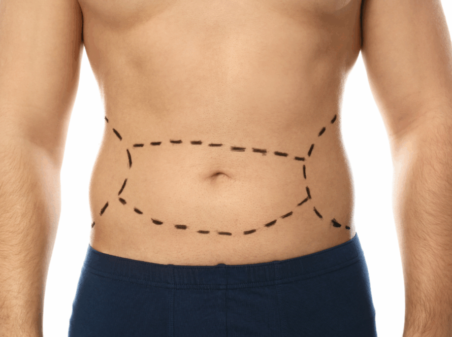 Who Are the Best Candidates for Non-Surgical Liposuction Treatments?
