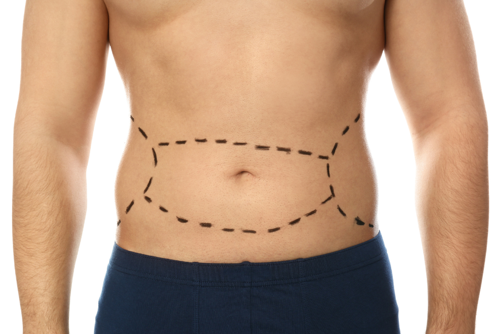 Who Are the Best Candidates for Non-Surgical Liposuction Treatments?