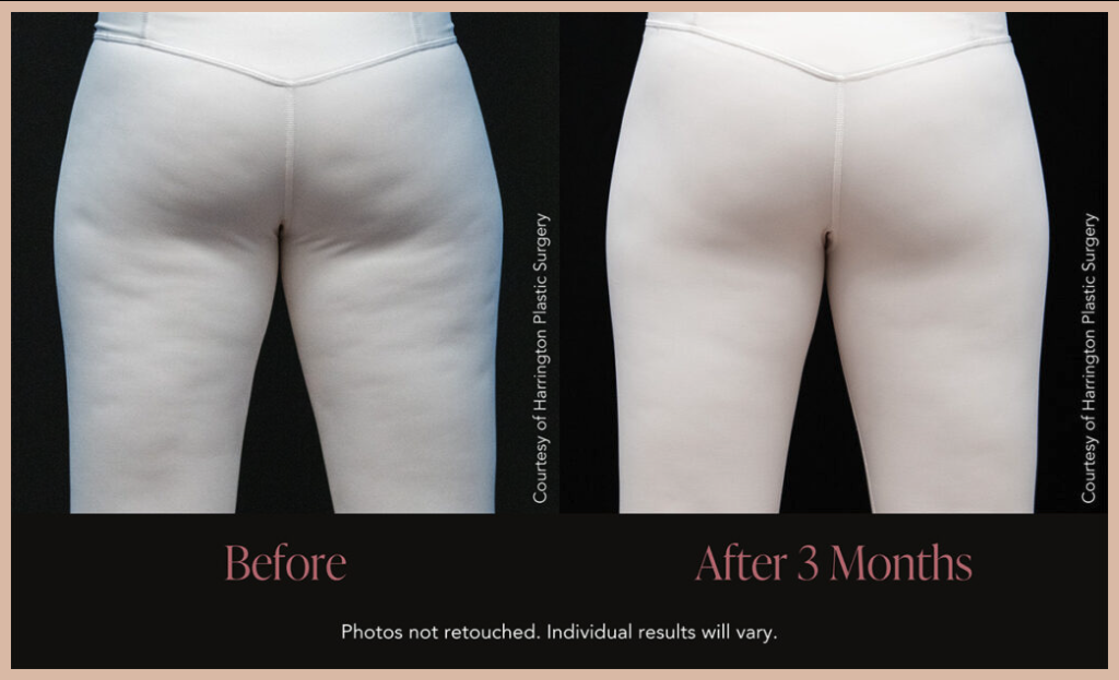 Aveli Before and After