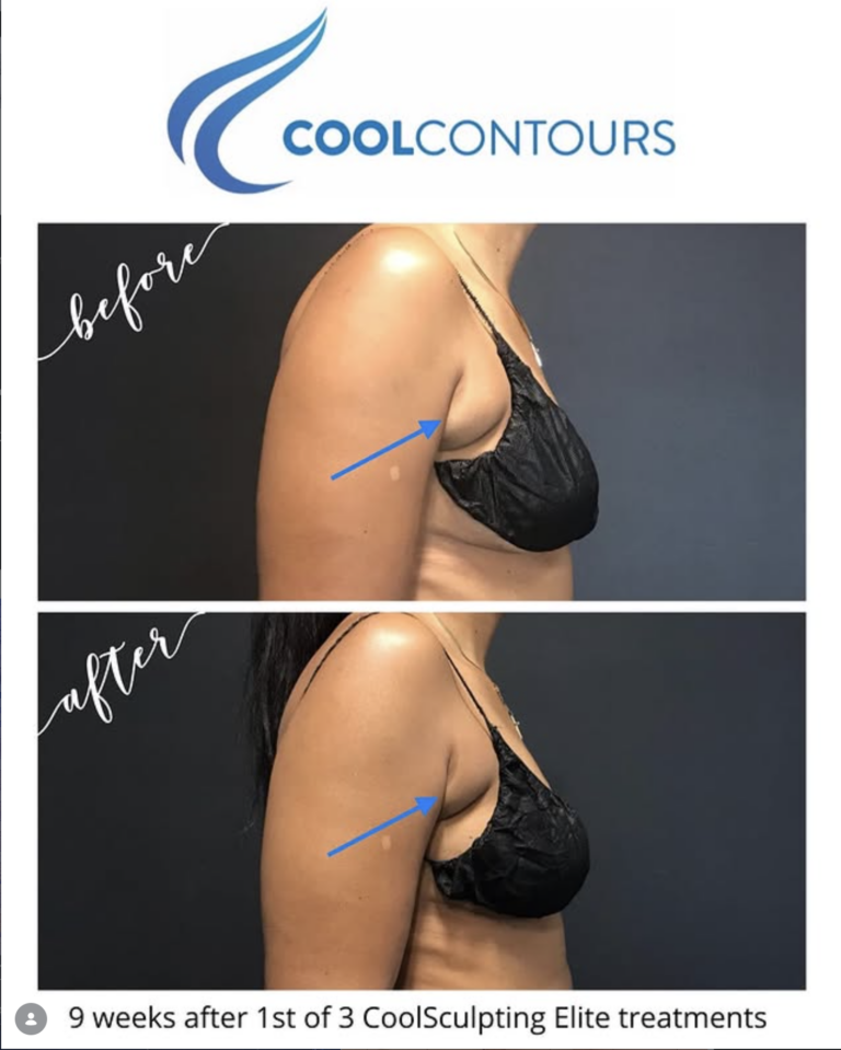 CoolSculpting Armpit Fat Before and After Results