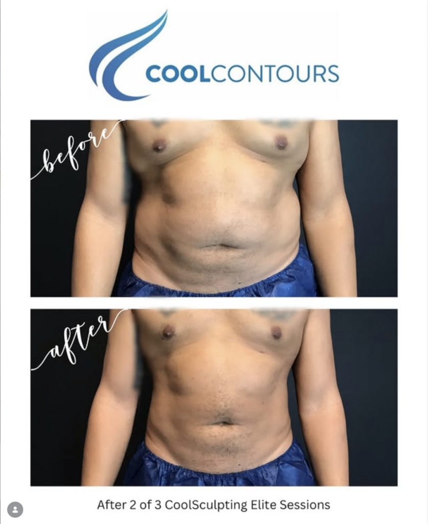CoolSculpting Male Flank Results from Cool Contours in Arlington VA