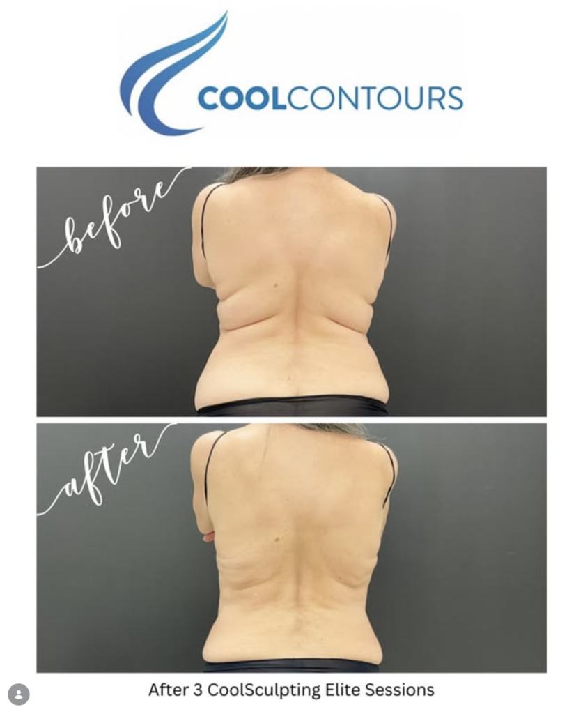 CoolSculpting Results in Arlington, VA - Flank or Love Handle Results Female Client