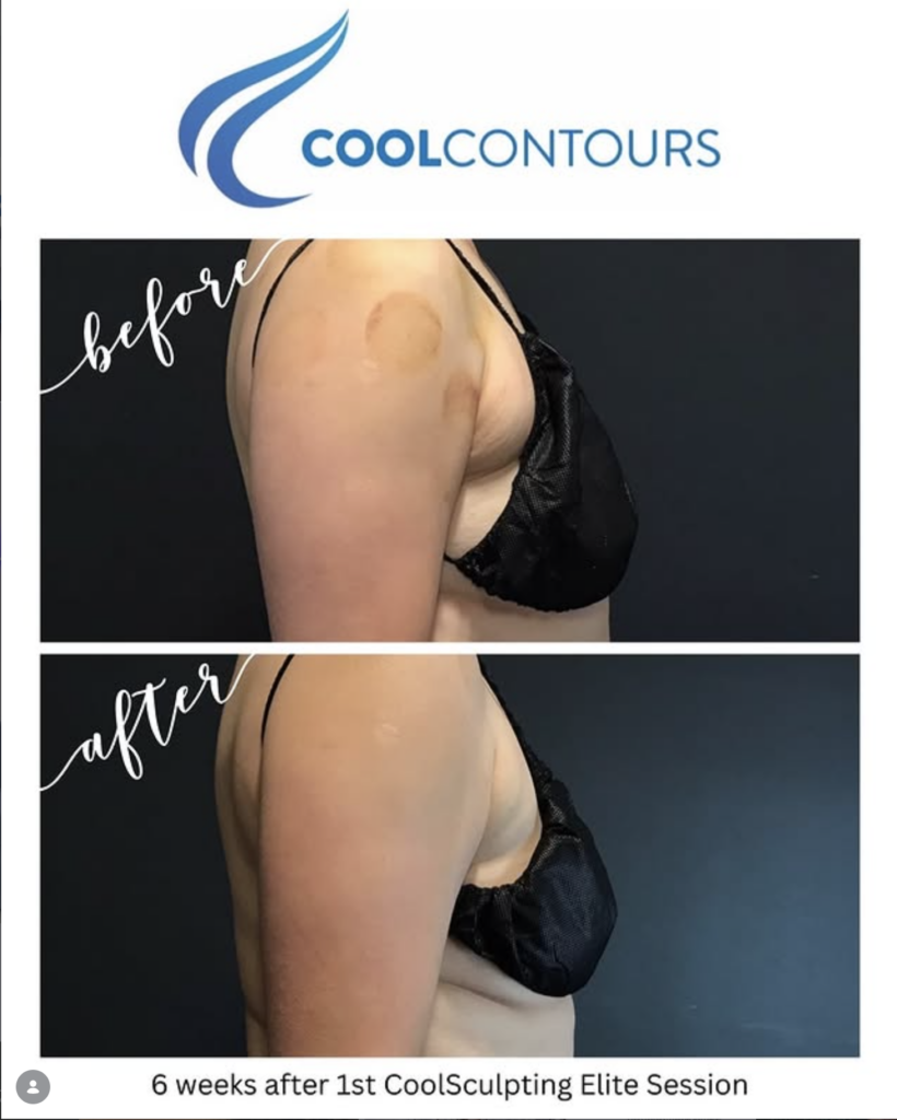CoolSculpting arm and bra fat before and after at Cool Contours in Arlington, VA