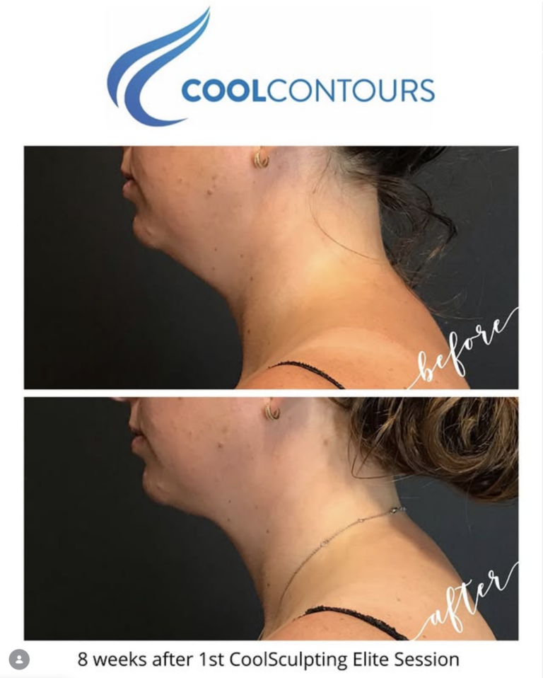 Female client results from CoolSculpting double chin - treated by Cool Contours in Northern Virginia