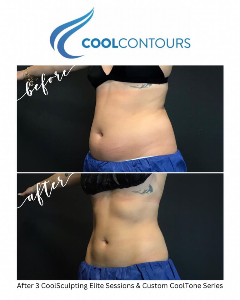Female client results from CoolSculpting and CoolTone treatments combined on Abdomen