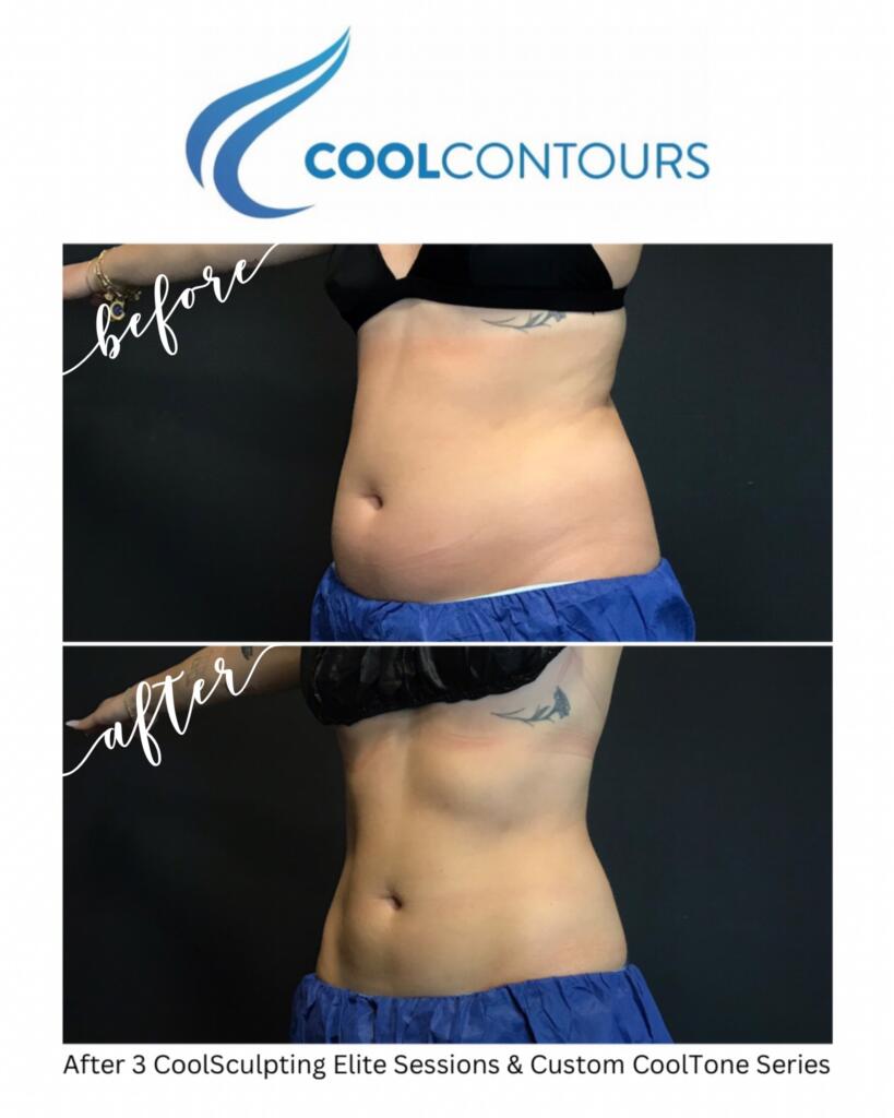 Female client results from CoolSculpting and CoolTone treatments combined on Abdomen