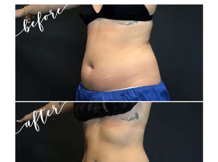 Female client results from CoolSculpting and CoolTone treatments combined on Abdomen