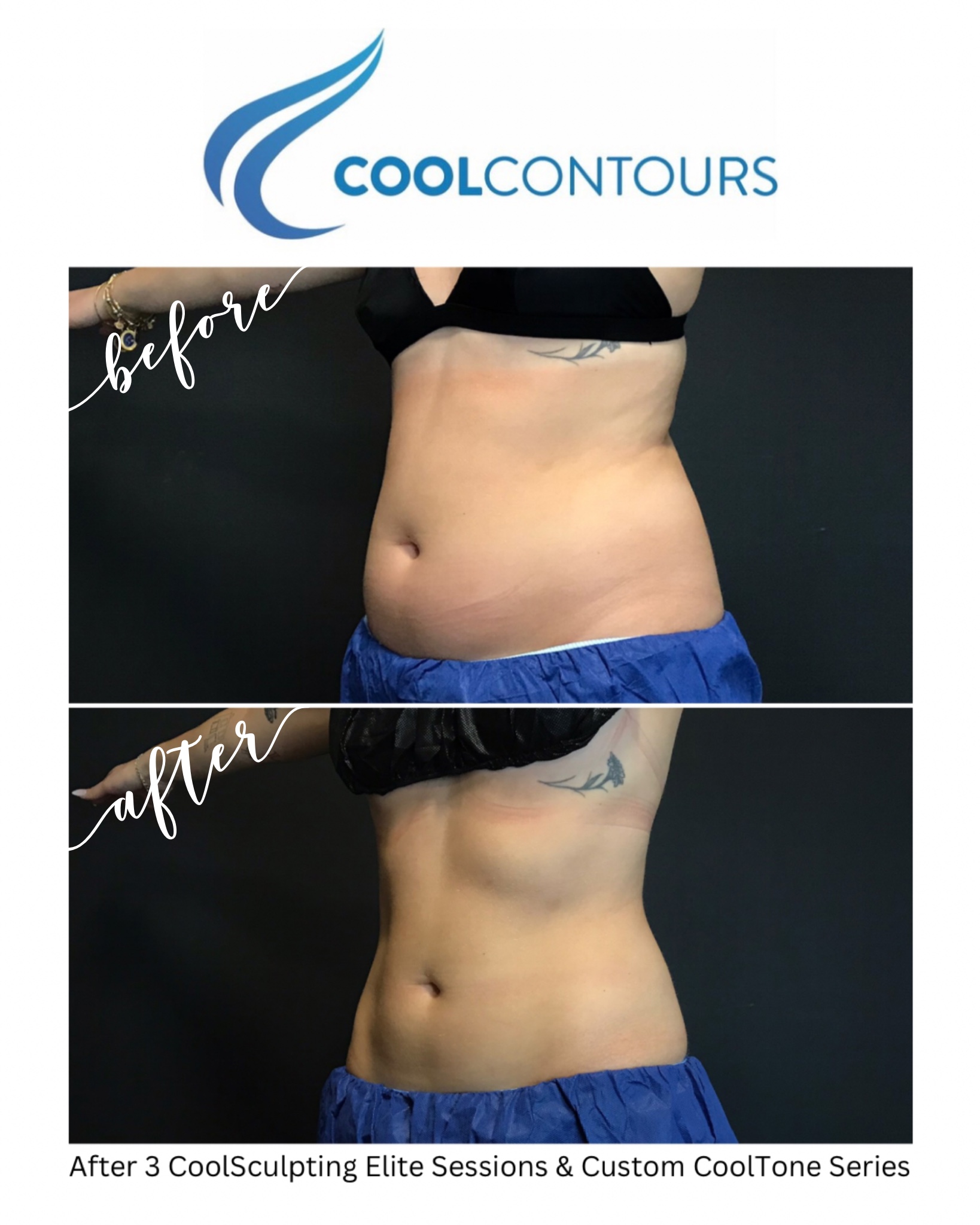 Female client results from CoolSculpting and CoolTone treatments combined on Abdomen