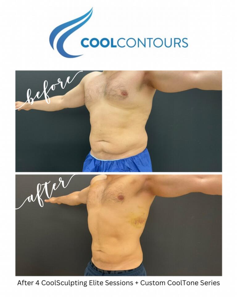 Before and after CoolSculpting Elite and CoolTone treatment showing reduced abdominal fat and improved waistline definition in a male patient.