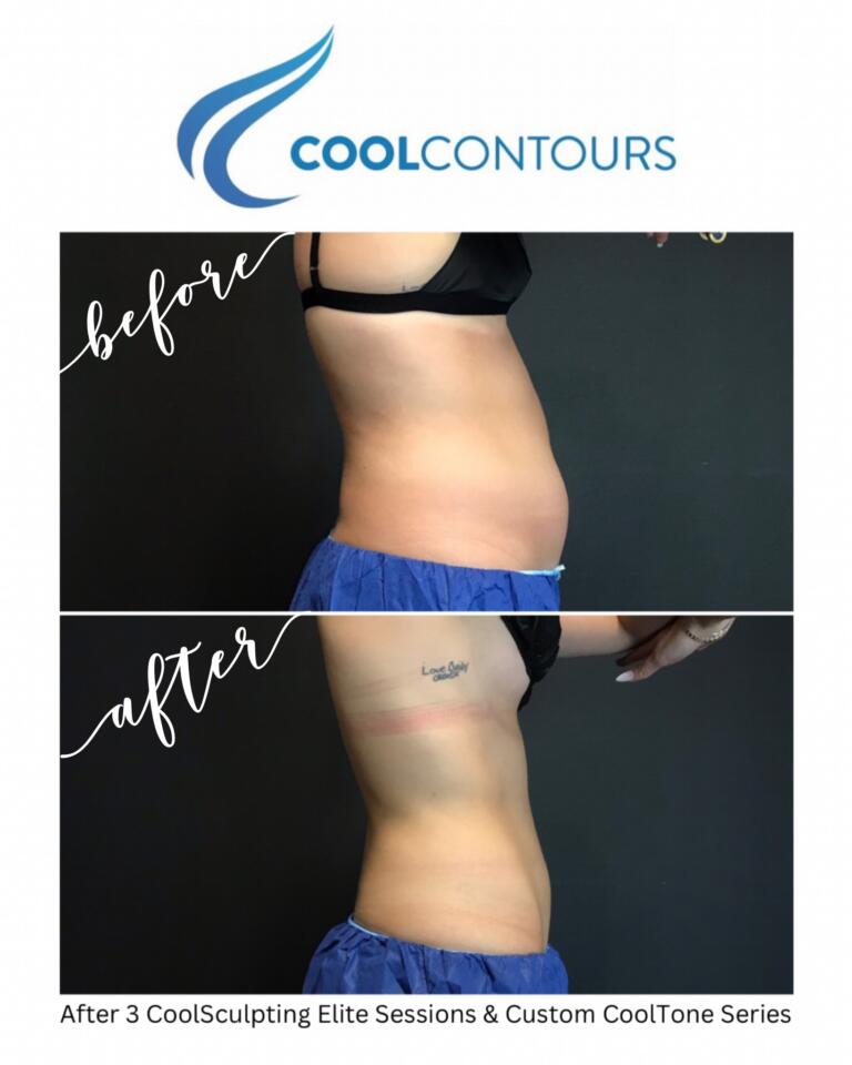 Female client treated with CoolSculpting and CoolTone results side profile abdomen treatment