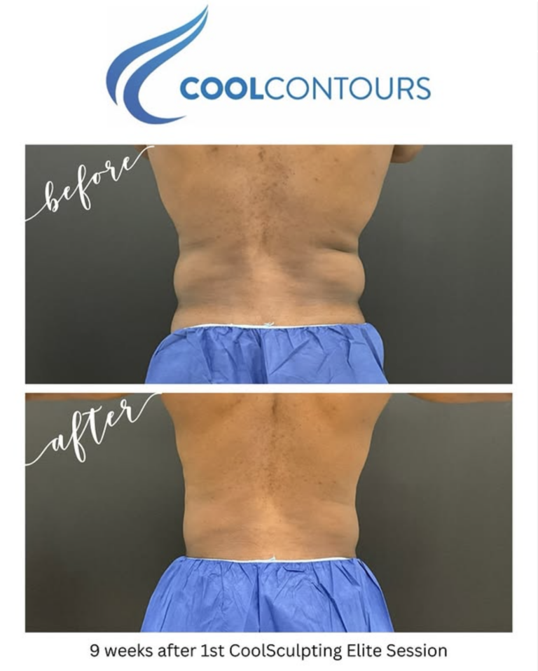 CoolSculpting Results Male Client Arlington VA from Cool Contours