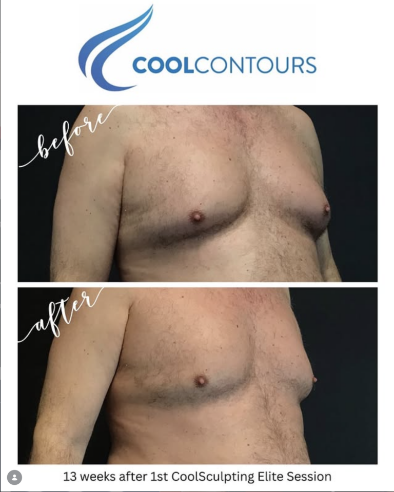 CoolSculpting Results Male Chest from Cool Contours in Arlington VA