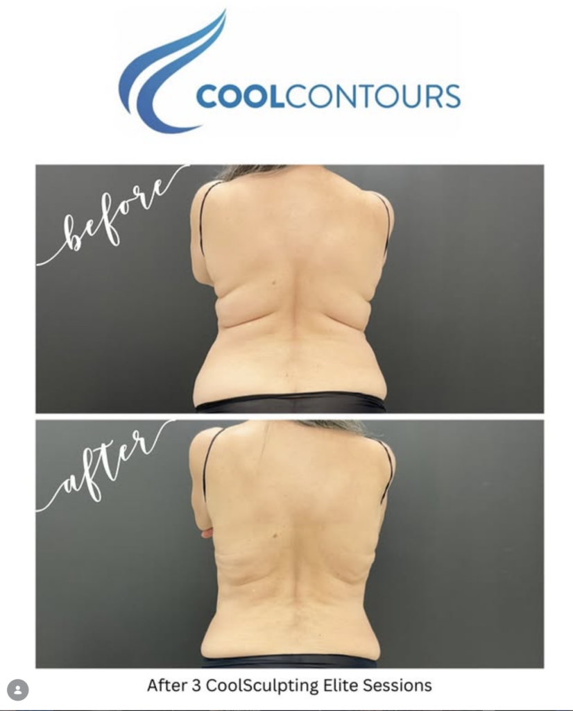 CoolSculpting results back fat and bra fat for female client treated in Northern Virginia at Cool Contours