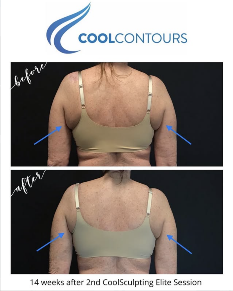 CoolSculpting Bra Fat Before and After Photos Female Client