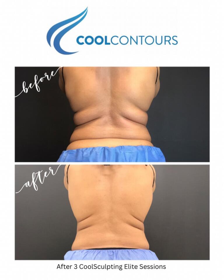 CoolSculpting results for female client treated along her love handles and waist