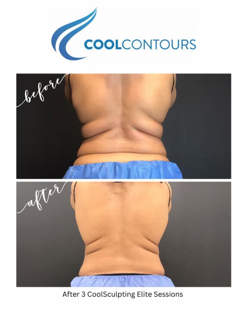 CoolSculpting results for female client treated along her love handles and waist