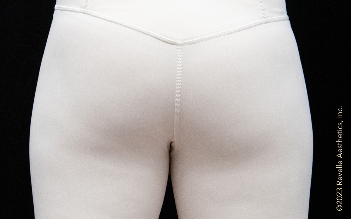 3 months after one Avéli treatment: smoother thighs and buttocks