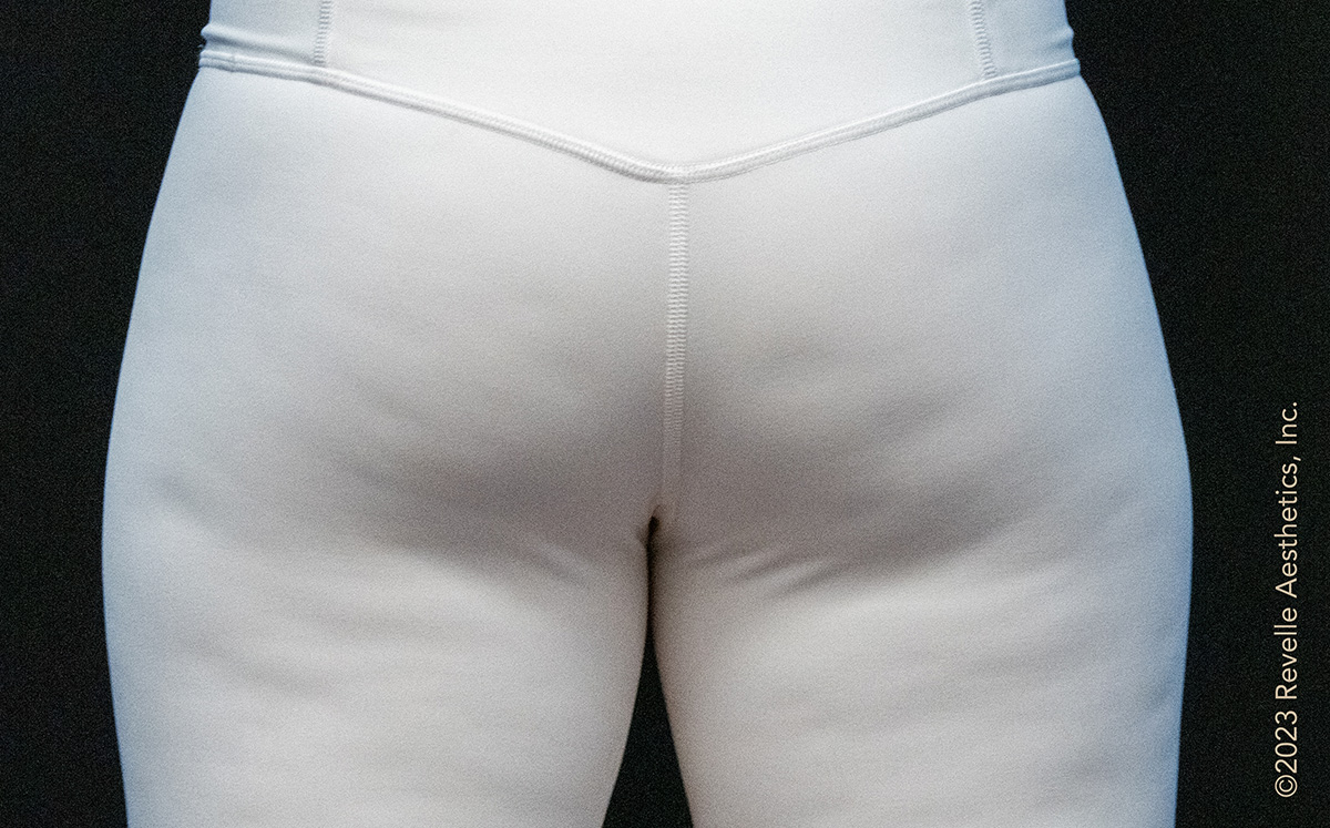 Before Avéli: cellulite dimples on the back of the thighs and buttocks