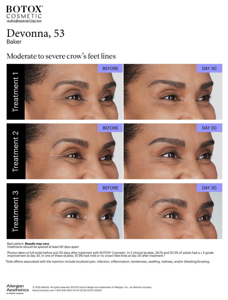 BOTOX® Cosmetic before and after, crow’s feet lines (Devonna, 53)