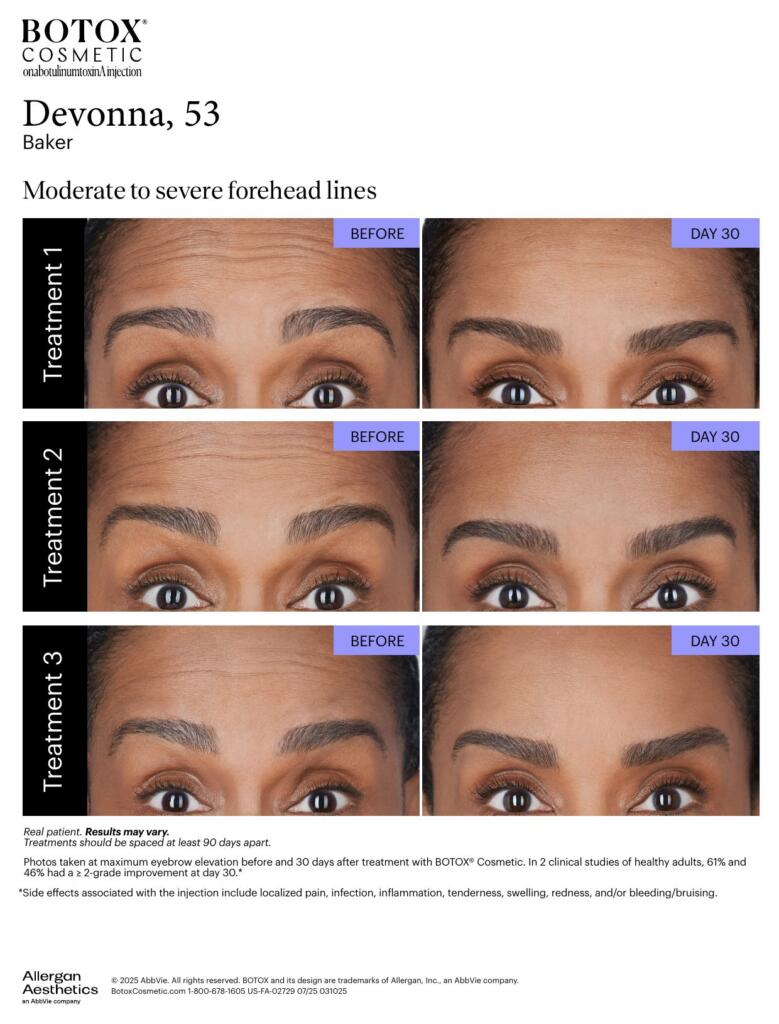 BOTOX® Cosmetic before and after, forehead lines (Devonna, 53)