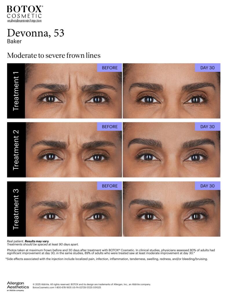 BOTOX® Cosmetic before and after, frown lines (Devonna, 53)