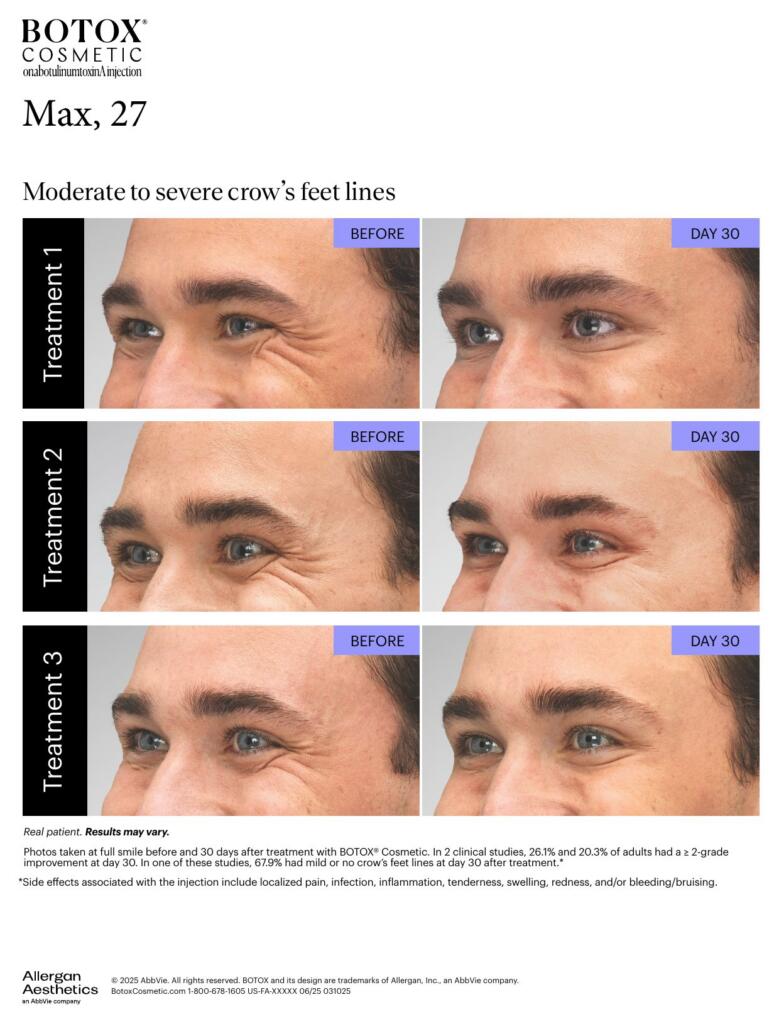 BOTOX® Cosmetic before and after, crow’s feet lines (Max, 27)