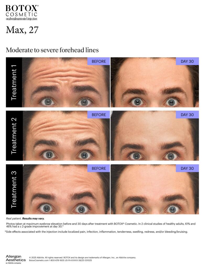 BOTOX® Cosmetic before and after, forehead lines (Max, 27)